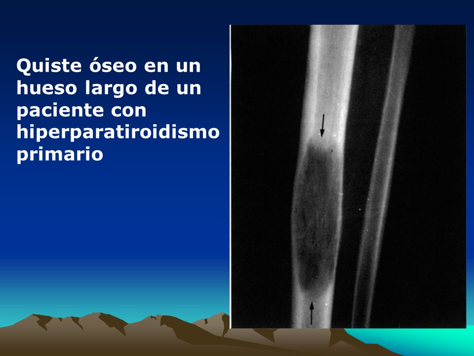 Quiste óseo en un hueso largo de un paciente con hiperparatiroidismo primario