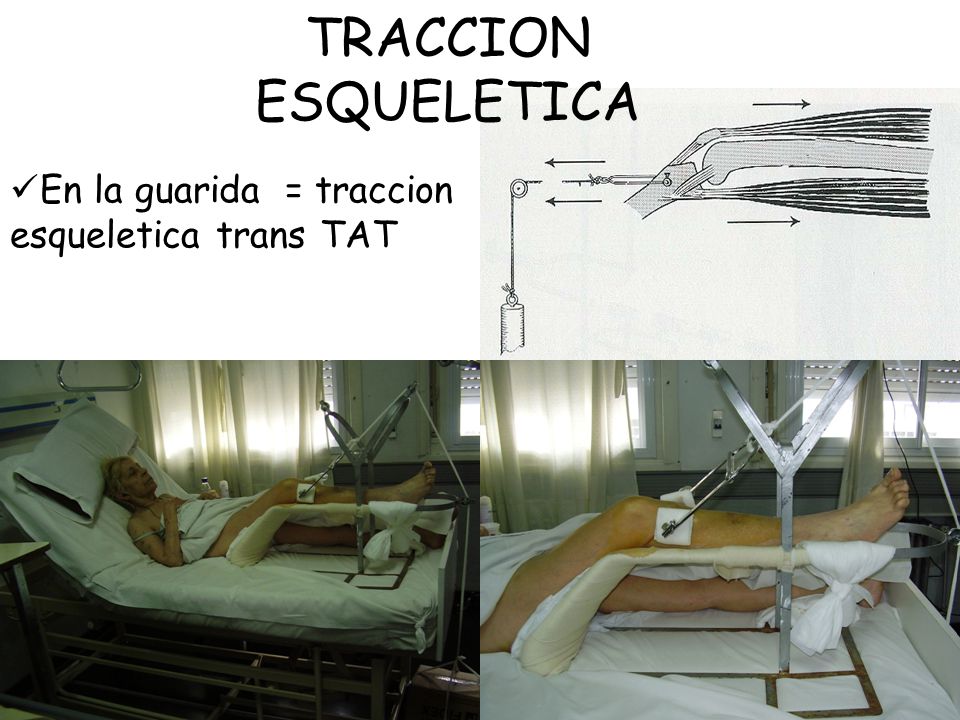 TRACCION ESQUELETICA En la guarida = traccion esqueletica trans TAT 1