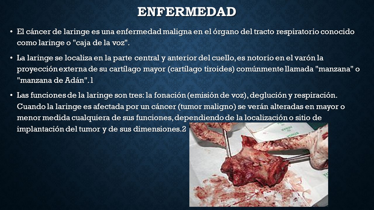 enfermedad El cáncer de laringe es una enfermedad maligna en el órgano del tracto respiratorio conocido como laringe o caja de la voz .