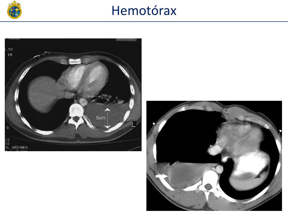 Hemotórax NO REALIZAR TORACOCENTESIS, el problema del TAC es q ve minimos hemotorax