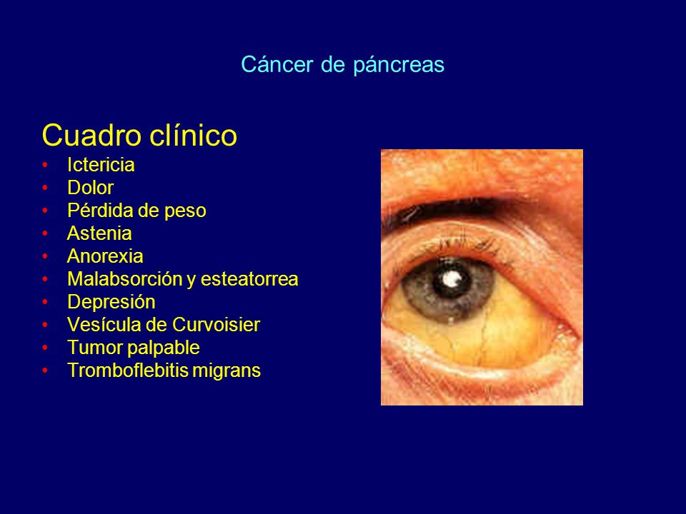 Cuadro clínico Cáncer de páncreas Ictericia Dolor Pérdida de peso