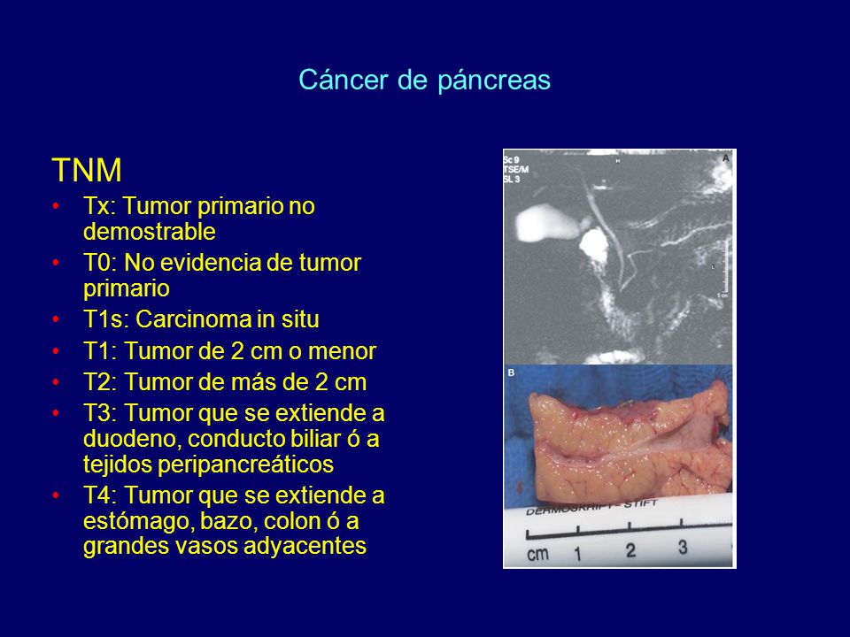 TNM Cáncer de páncreas Tx: Tumor primario no demostrable