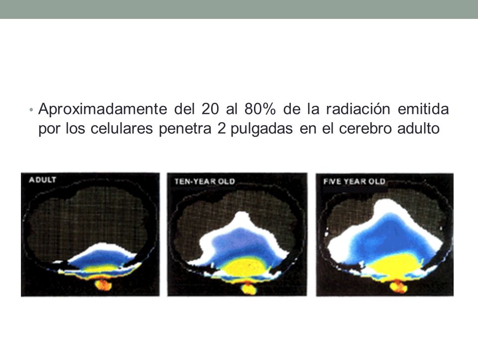 Aproximadamente del 20 al 80% de la radiación emitida por los celulares penetra 2 pulgadas en el cerebro adulto