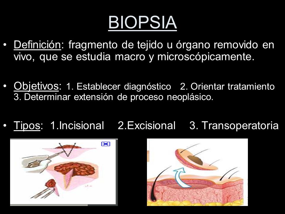 BIOPSIA Definición: fragmento de tejido u órgano removido en vivo, que se estudia macro y microscópicamente.