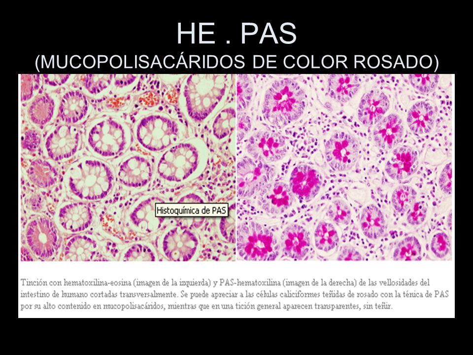 HE . PAS (MUCOPOLISACÁRIDOS DE COLOR ROSADO)