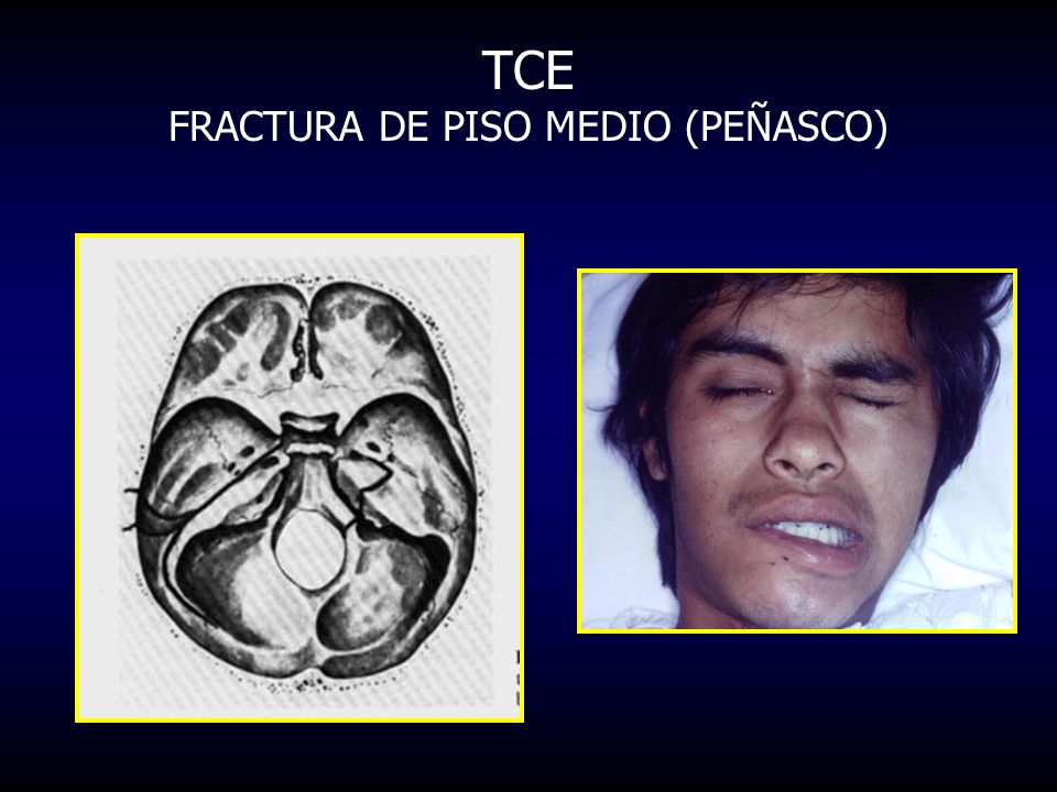 TCE FRACTURA DE PISO MEDIO (PEÑASCO)