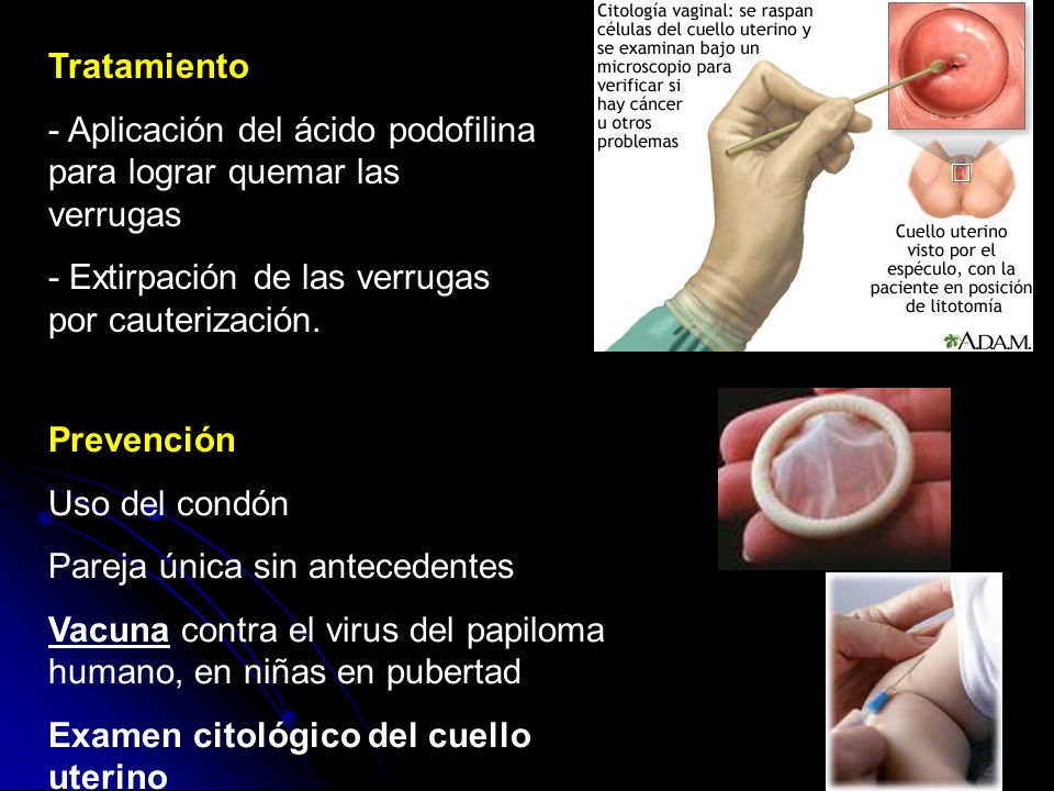 Tratamiento - Aplicación del ácido podofilina para lograr quemar las verrugas. - Extirpación de las verrugas por cauterización.