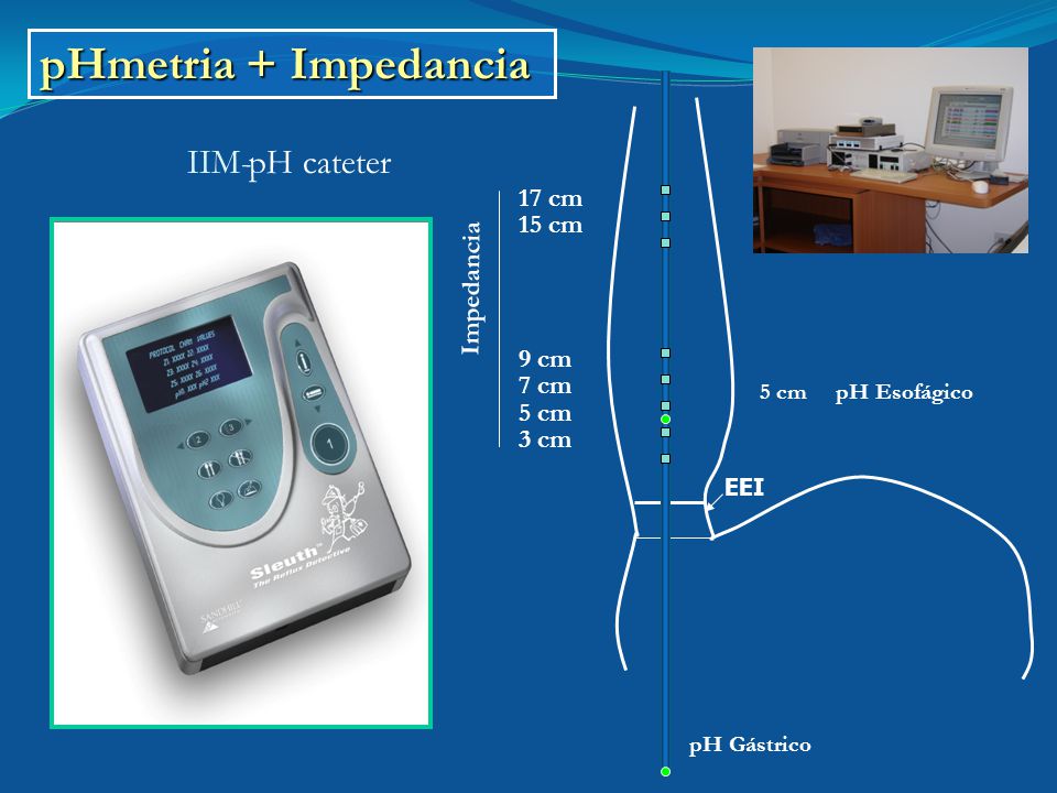 pHmetria + Impedancia IIM- pH cateter 17 cm 15 cm Impedancia 9 cm 7 cm
