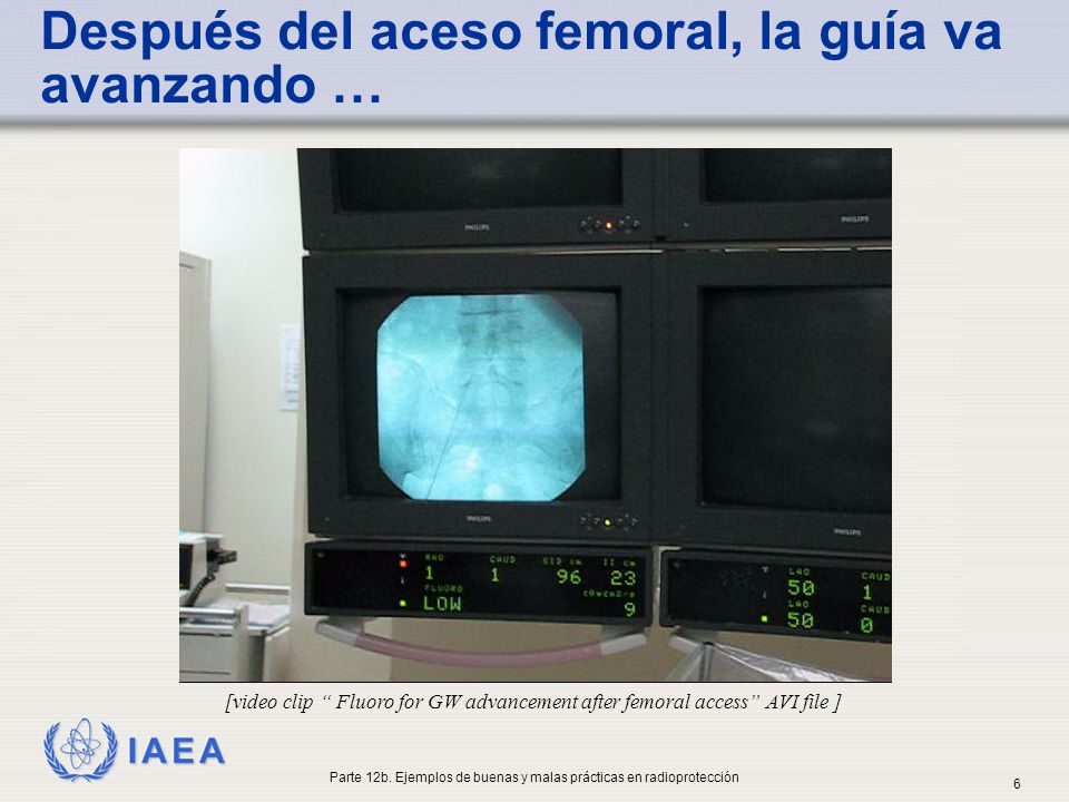 Después del aceso femoral, la guía va avanzando …