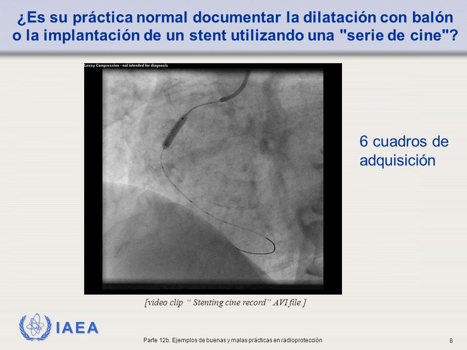 ¿Es su práctica normal documentar la dilatación con balón o la implantación de un stent utilizando una serie de cine