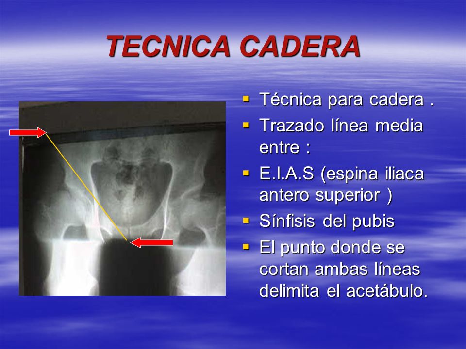 TECNICA CADERA Técnica para cadera . Trazado línea media entre :