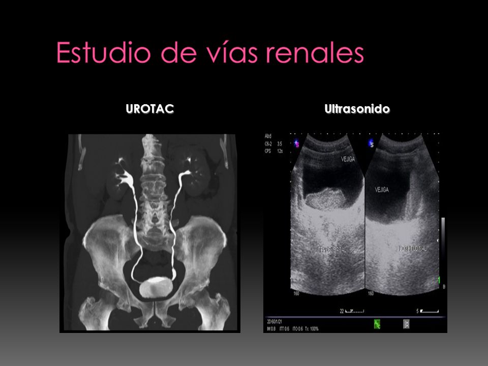 Estudio de vías renales
