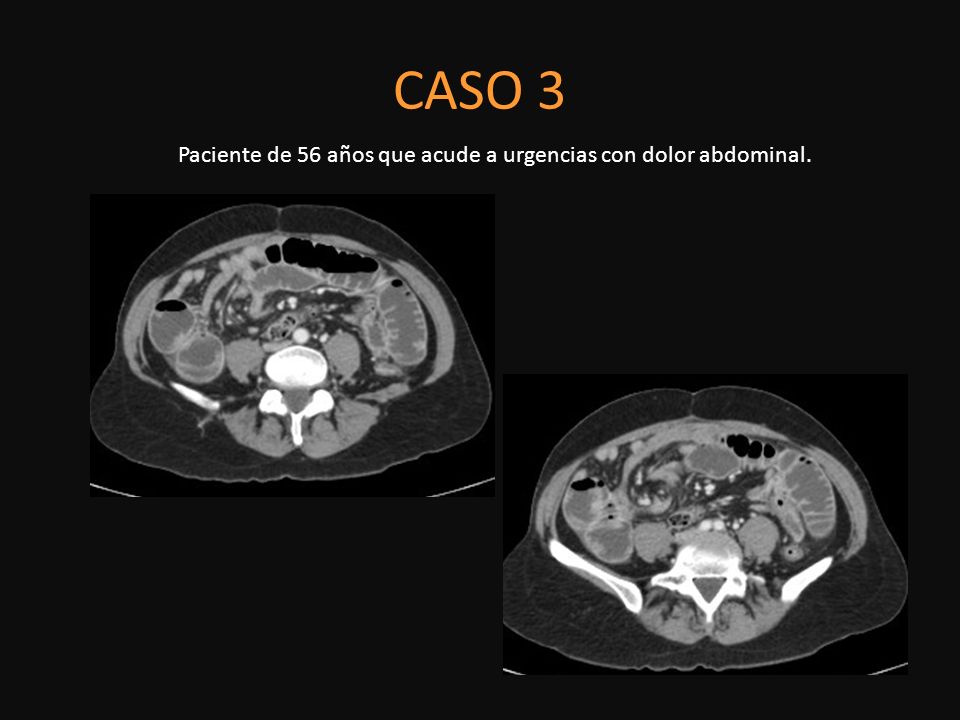 Paciente de 56 años que acude a urgencias con dolor abdominal.