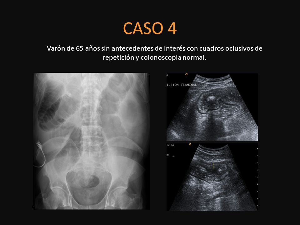 CASO 4 Varón de 65 años sin antecedentes de interés con cuadros oclusivos de repetición y colonoscopia normal.