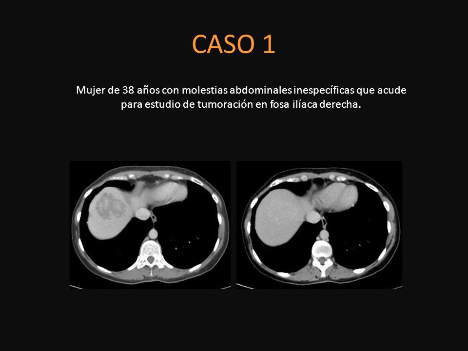 CASO 1 Mujer de 38 años con molestias abdominales inespecíficas que acude para estudio de tumoración en fosa ilíaca derecha.