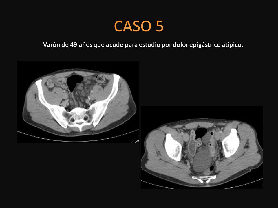 Varón de 49 años que acude para estudio por dolor epigástrico atípico.