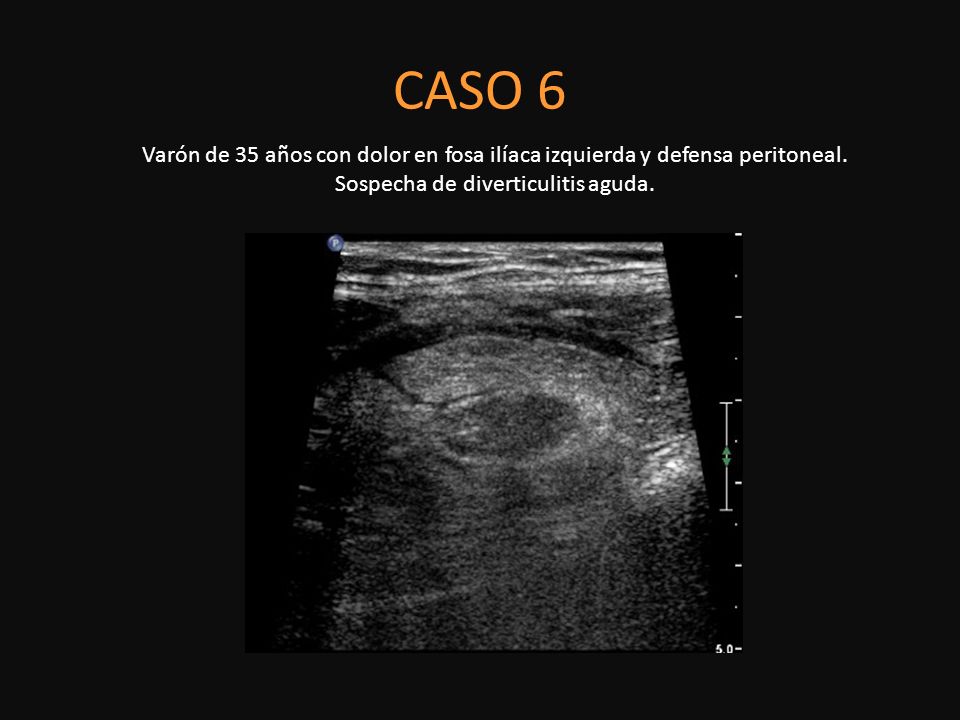 CASO 6 Varón de 35 años con dolor en fosa ilíaca izquierda y defensa peritoneal. Sospecha de diverticulitis aguda.