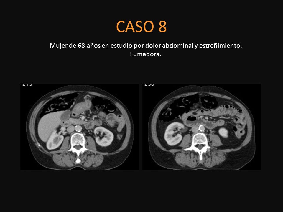 CASO 8 Mujer de 68 años en estudio por dolor abdominal y estreñimiento. Fumadora.