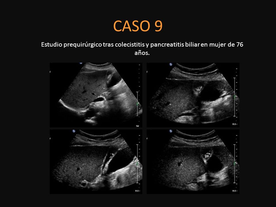 CASO 9 Estudio prequirúrgico tras colecistitis y pancreatitis biliar en mujer de 76 años.
