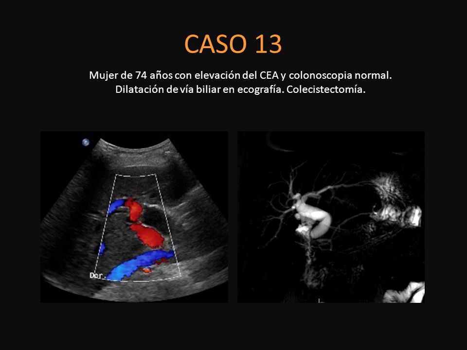 CASO 13 Mujer de 74 años con elevación del CEA y colonoscopia normal. Dilatación de vía biliar en ecografía. Colecistectomía.