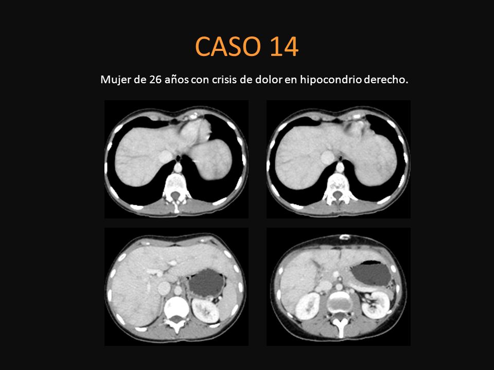 Mujer de 26 años con crisis de dolor en hipocondrio derecho.