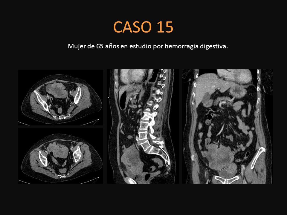 Mujer de 65 años en estudio por hemorragia digestiva.