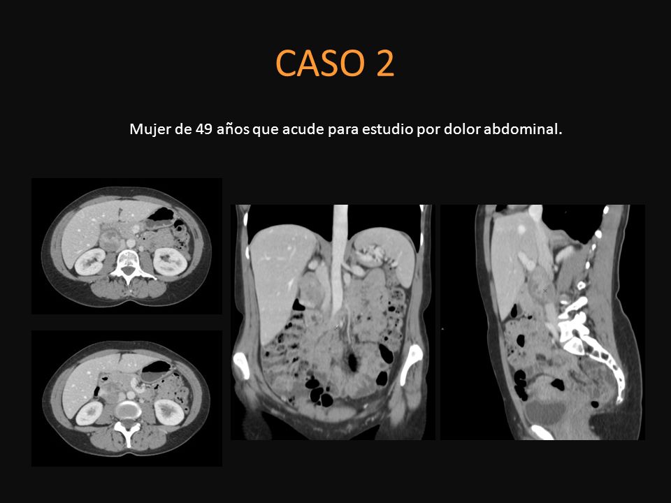 Mujer de 49 años que acude para estudio por dolor abdominal.