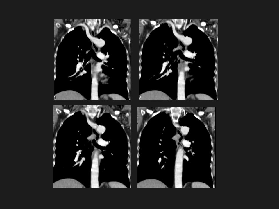 Reconstrucciones coronales del TC donde se aprecia que la estructura vascular que se origina del cayado aórtico se dirige hacia el lado derecho y corresponde claramente a una arteria subclavia derecha aberrante.