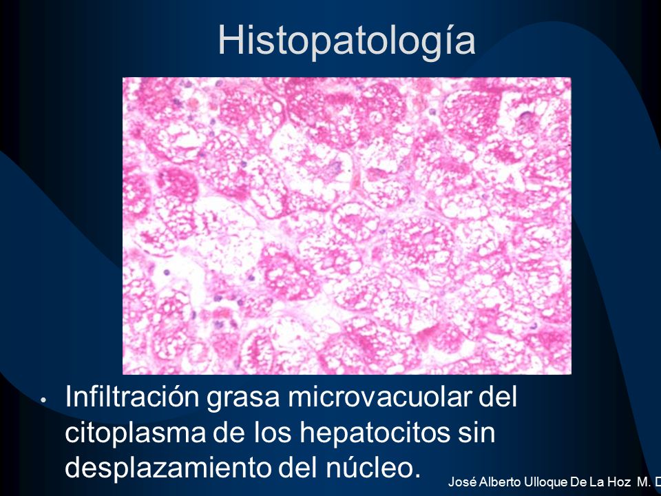 Histopatología Infiltración grasa microvacuolar del citoplasma de los hepatocitos sin desplazamiento del núcleo.
