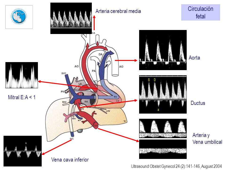 Circulación fetal Arteria cerebral media Aorta Mitral E:A < 1