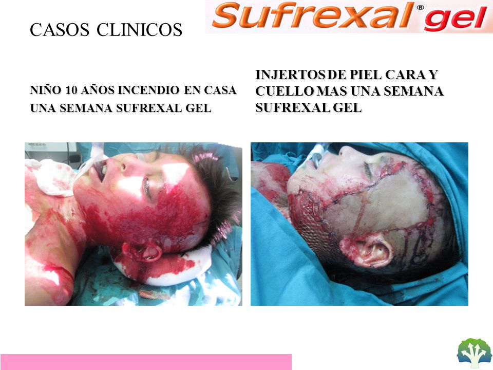 CASOS CLINICOS NIÑO 10 AÑOS INCENDIO EN CASA. UNA SEMANA SUFREXAL GEL.