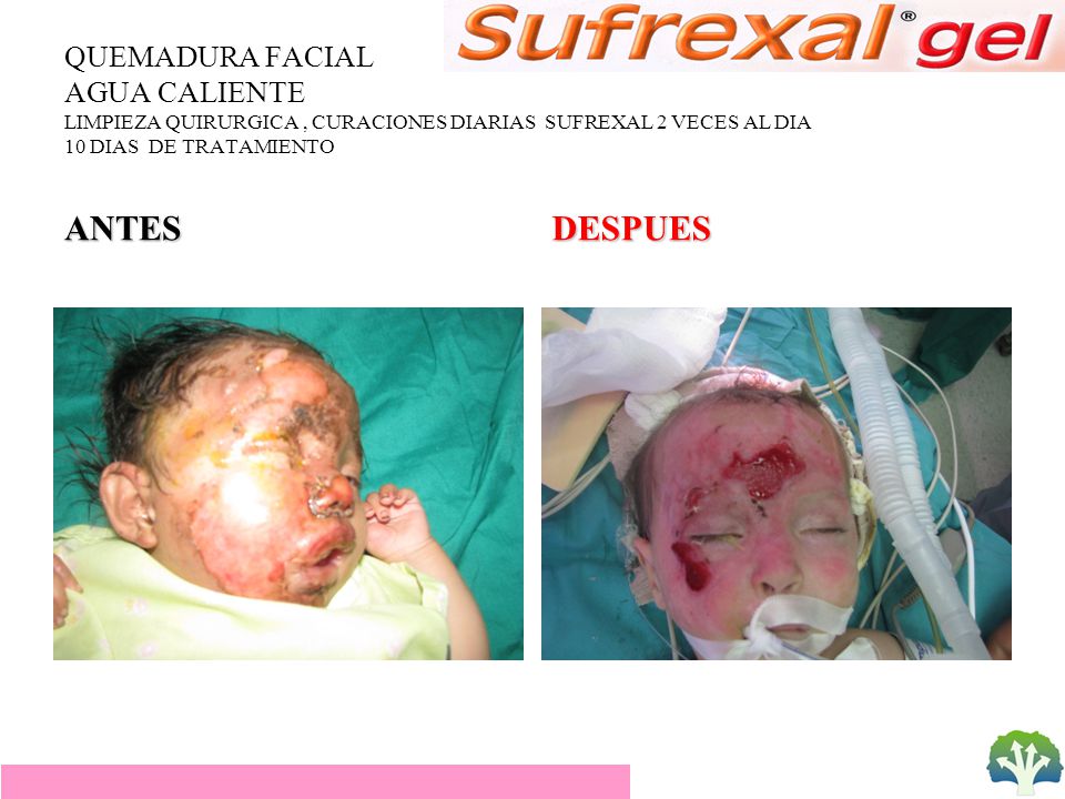 QUEMADURA FACIAL AGUA CALIENTE LIMPIEZA QUIRURGICA , CURACIONES DIARIAS SUFREXAL 2 VECES AL DIA 10 DIAS DE TRATAMIENTO