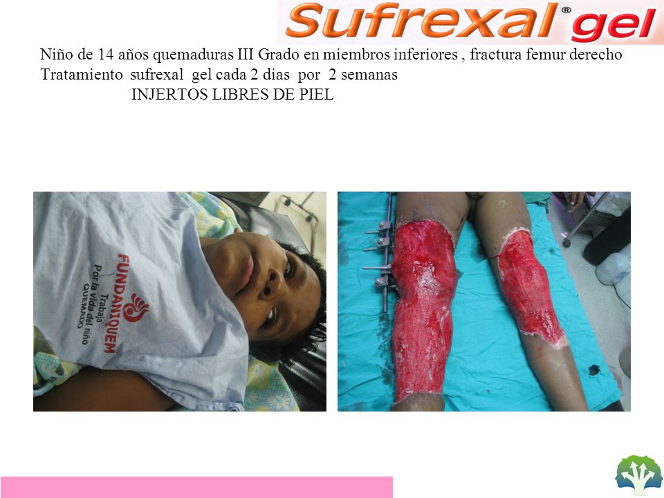 Niño de 14 años quemaduras III Grado en miembros inferiores , fractura femur derecho Tratamiento sufrexal gel cada 2 dias por 2 semanas INJERTOS LIBRES DE PIEL