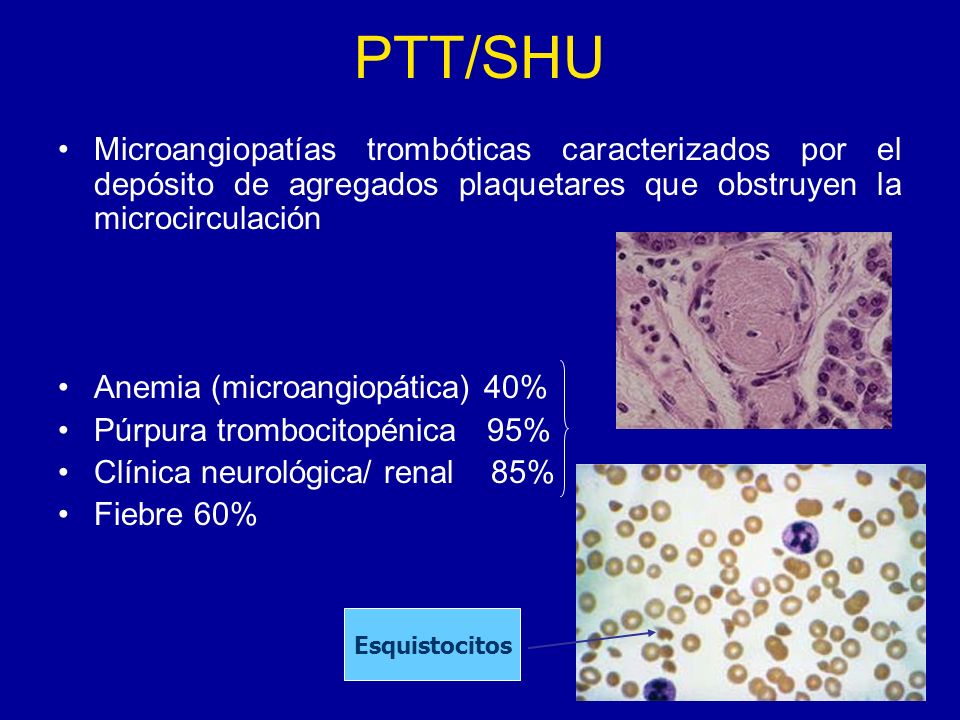 PTT/SHU Microangiopatías trombóticas caracterizados por el depósito de agregados plaquetares que obstruyen la microcirculación.