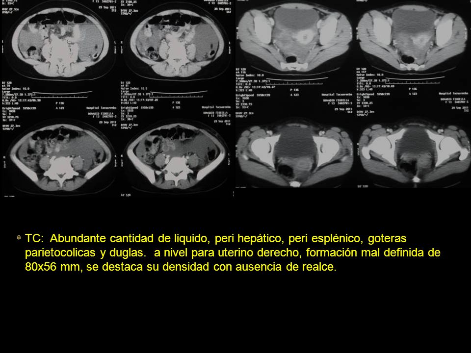 TC: Abundante cantidad de liquido, peri hepático, peri esplénico, goteras parietocolicas y duglas.