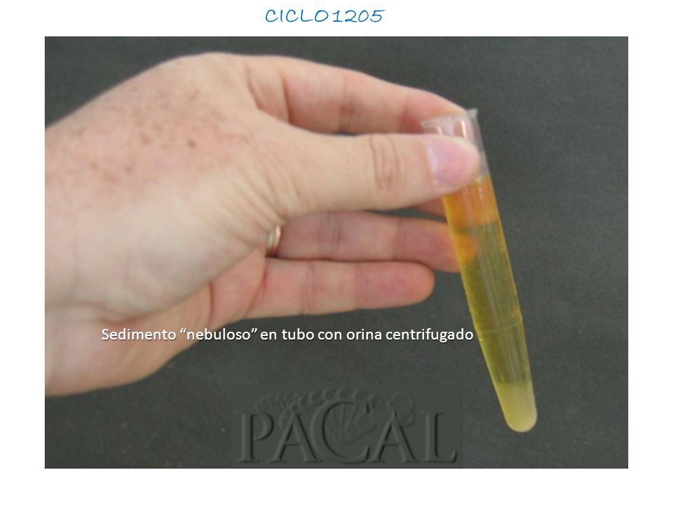 CICLO 1205 Sedimento nebuloso en tubo con orina centrifugado