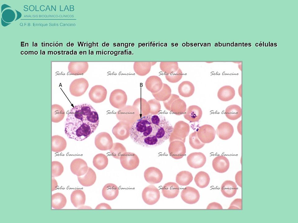 En la tinción de Wright de sangre periférica se observan abundantes células como la mostrada en la micrografía.
