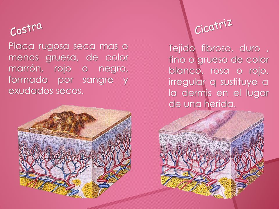 Costra Cicatriz. Placa rugosa seca mas o menos gruesa, de color marrón, rojo o negro, formado por sangre y exudados secos.