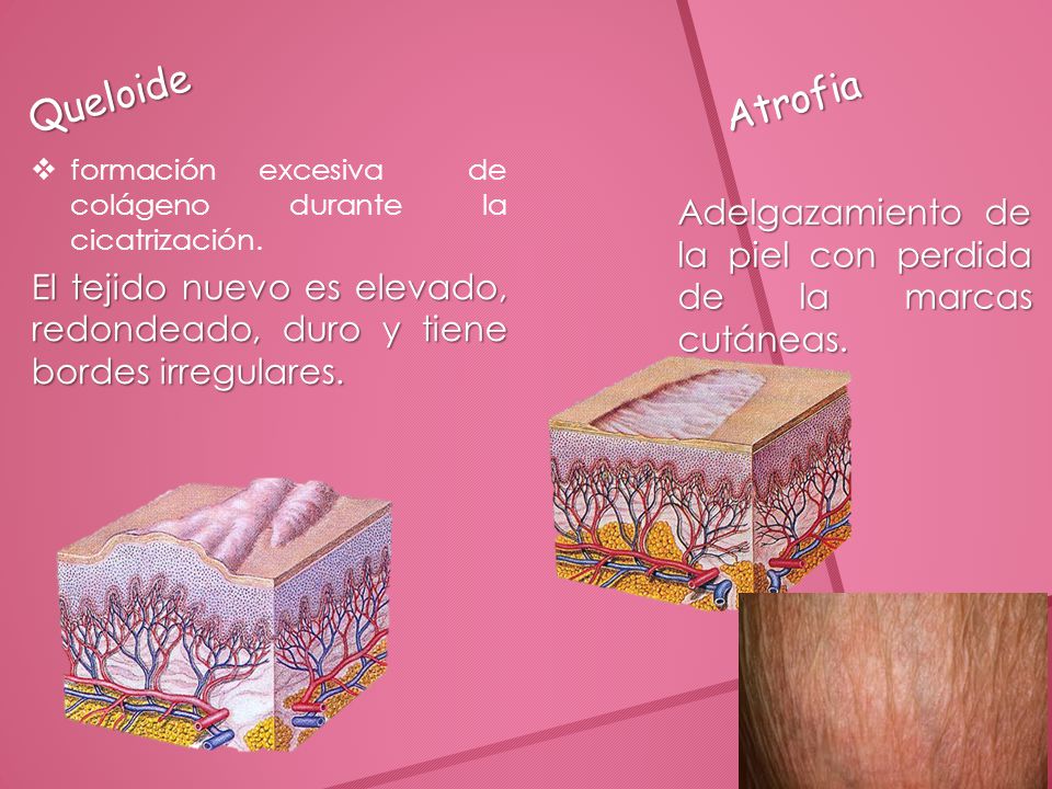 Queloide Atrofia. formación excesiva de colágeno durante la cicatrización.