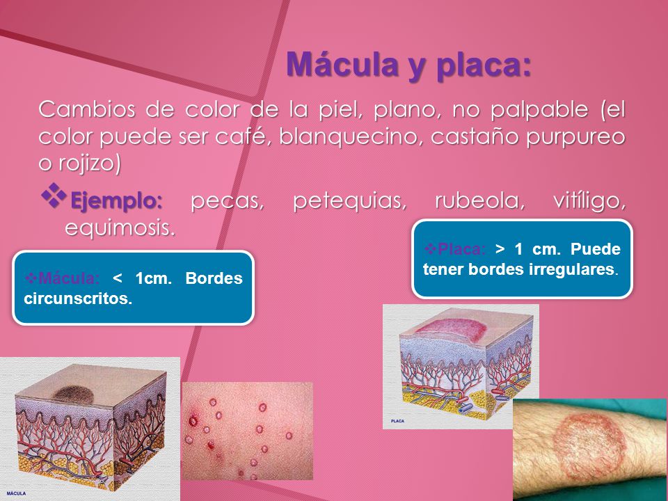 Mácula y placa: Cambios de color de la piel, plano, no palpable (el color puede ser café, blanquecino, castaño purpureo o rojizo)