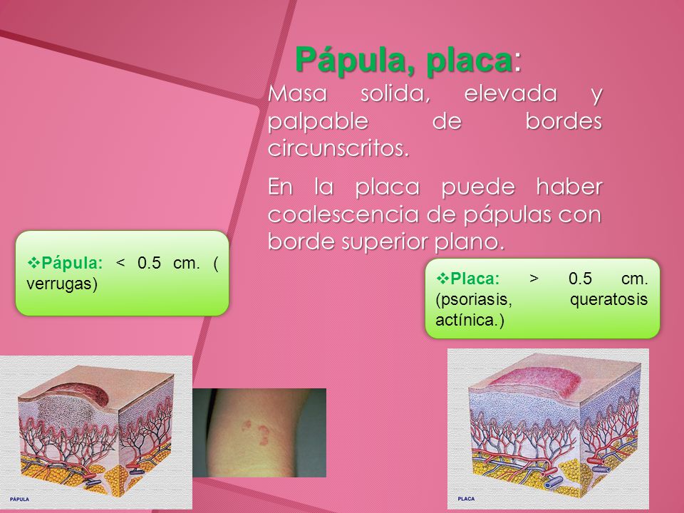Pápula, placa: Masa solida, elevada y palpable de bordes circunscritos. En la placa puede haber coalescencia de pápulas con borde superior plano.