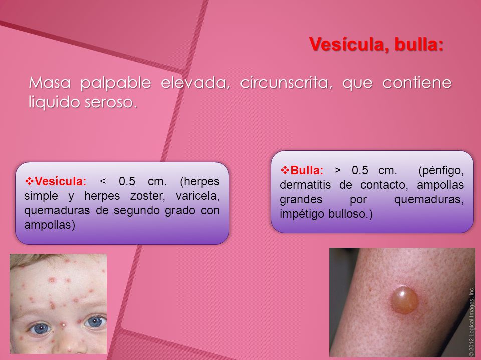 Vesícula, bulla: Masa palpable elevada, circunscrita, que contiene liquido seroso.