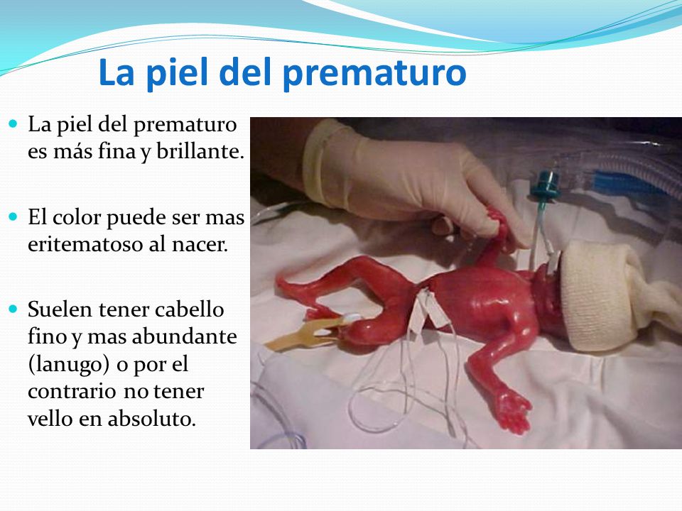 La piel del prematuro La piel del prematuro es más fina y brillante.