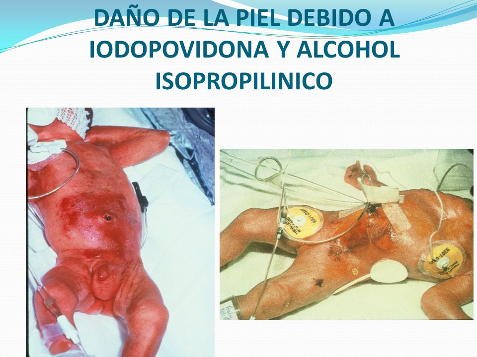 DAÑO DE LA PIEL DEBIDO A IODOPOVIDONA Y ALCOHOL ISOPROPILINICO