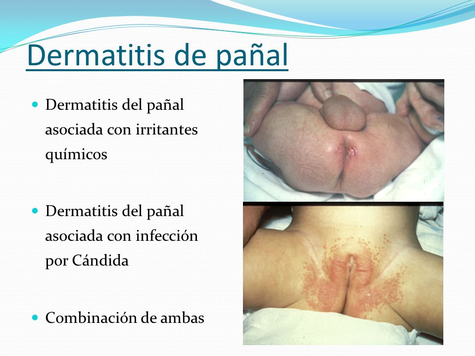 Dermatitis de pañal Dermatitis del pañal asociada con irritantes químicos. Dermatitis del pañal asociada con infección por Cándida.