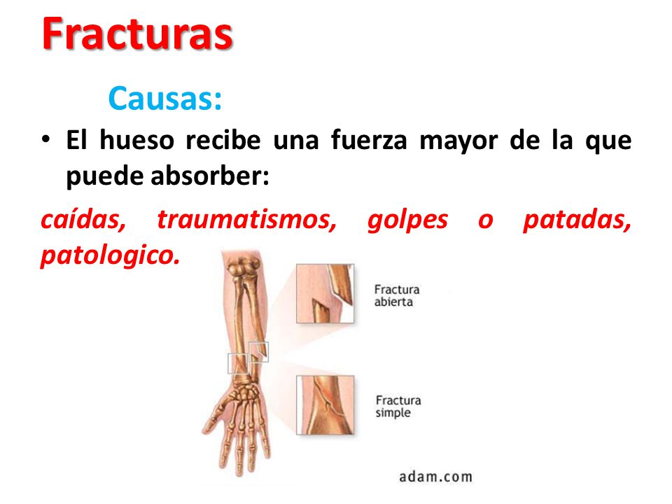 Fracturas Causas: El hueso recibe una fuerza mayor de la que puede absorber: caídas, traumatismos, golpes o patadas, patologico.