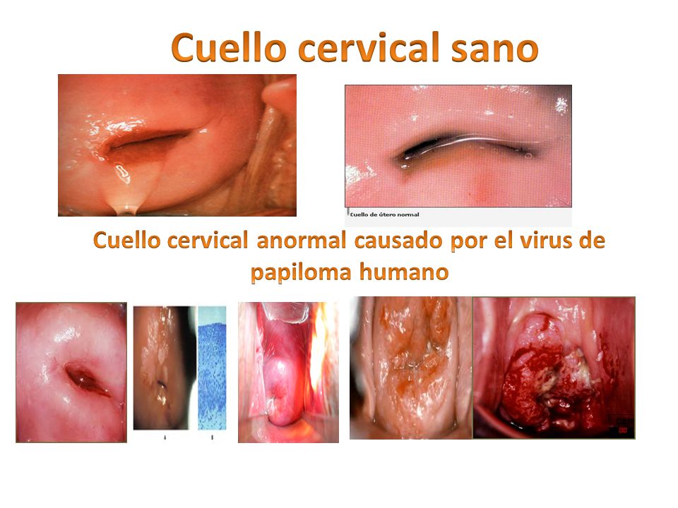 Cuello cervical anormal causado por el virus de papiloma humano
