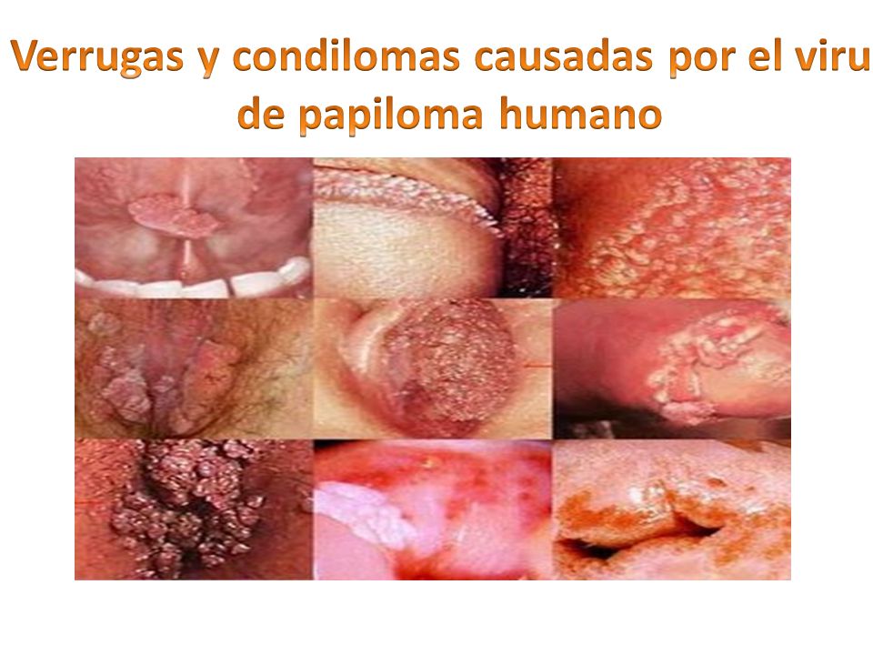 Verrugas y condilomas causadas por el virus de papiloma humano