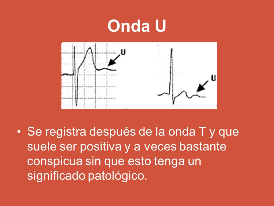 Onda U Se registra después de la onda T y que suele ser positiva y a veces bastante conspicua sin que esto tenga un significado patológico.