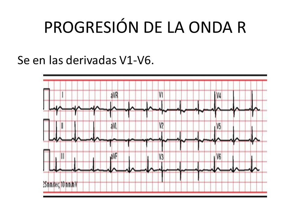 PROGRESIÓN DE LA ONDA R Se en las derivadas V1-V6.